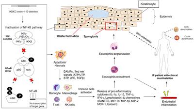 Uncovering incontinentia pigmenti: From DNA sequence to pathophysiology